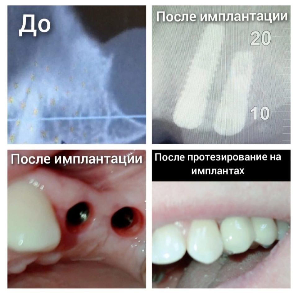 Врач-стоматолог-терапевт-хирург-ортопед-Дарбинян-Артак-Владимирович_имплантация